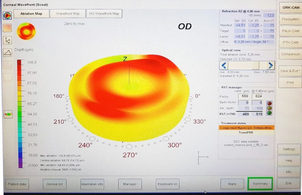Cirurgias Refrativas Curitiba
