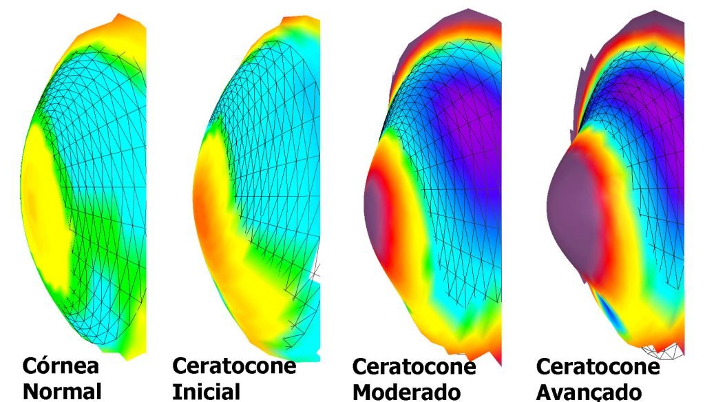 cornea com ceratocone