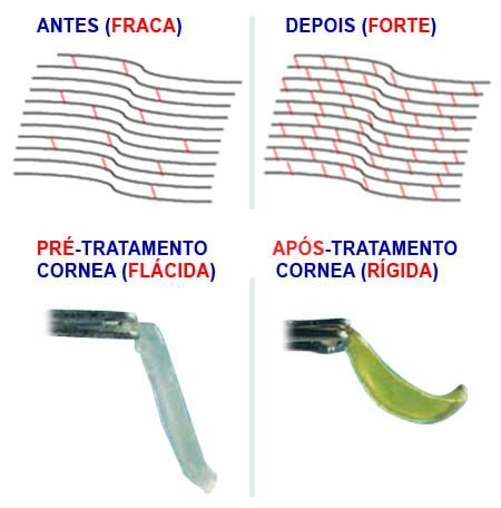 crosslinking para ceratocone