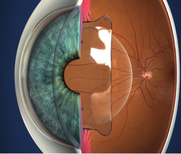 lentes intraoculares fácicas curitiba
