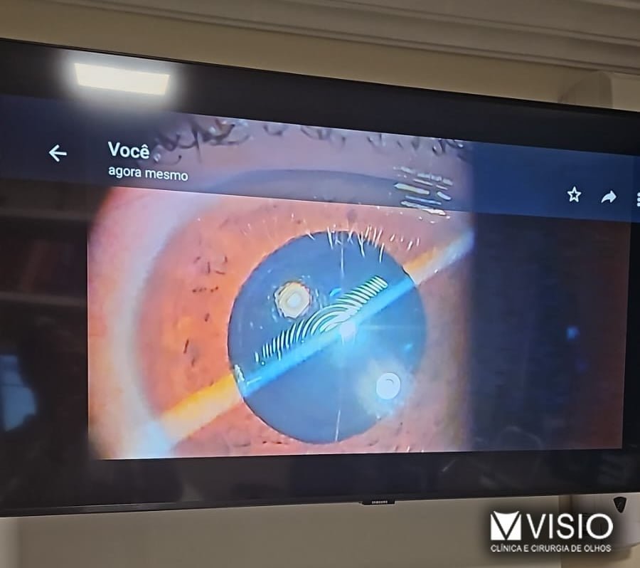 lente intraocular torica